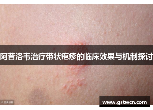 阿昔洛韦治疗带状疱疹的临床效果与机制探讨